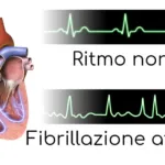 La Fibrillazione Atriale